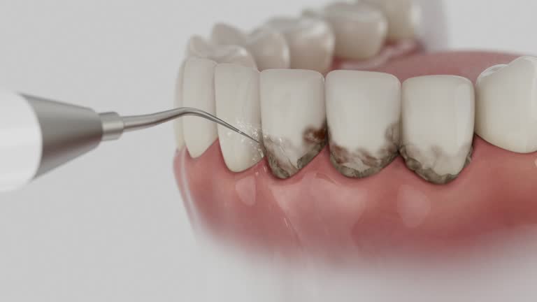 Reliable Tooth Extraction contractor in Cranston, RI by Smile Center Dentistry